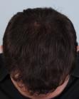 After Hair Transplant&nbsp;Front